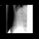 Fracture of vertebra L1: X-ray - Plain radiograph
